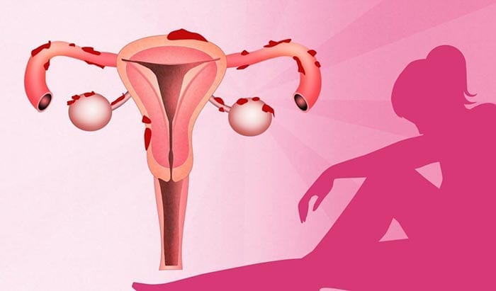 ¿Qué es la endometriosis y cómo afecta a la fertilidad?
