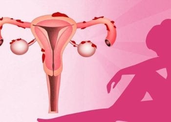 ¿Qué es la endometriosis y cómo afecta a la fertilidad?