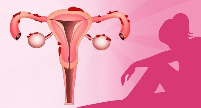 ¿Qué es la endometriosis y cómo afecta a la fertilidad?