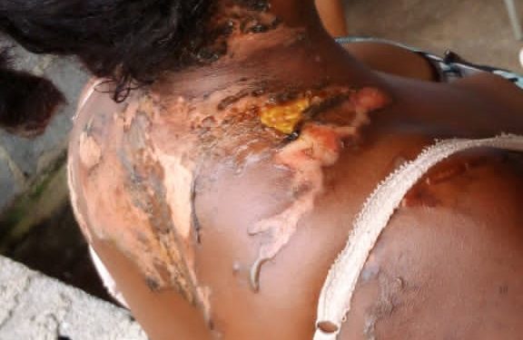 Violencia doméstica: detenido el presidente de la comunidad de Camaremi por quemar con sopa caliente a su esposa