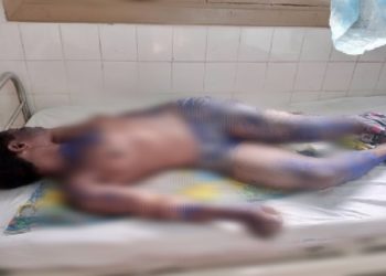 Madre e hijo ingresados por graves quemaduras supuestamente causadas por una curandera